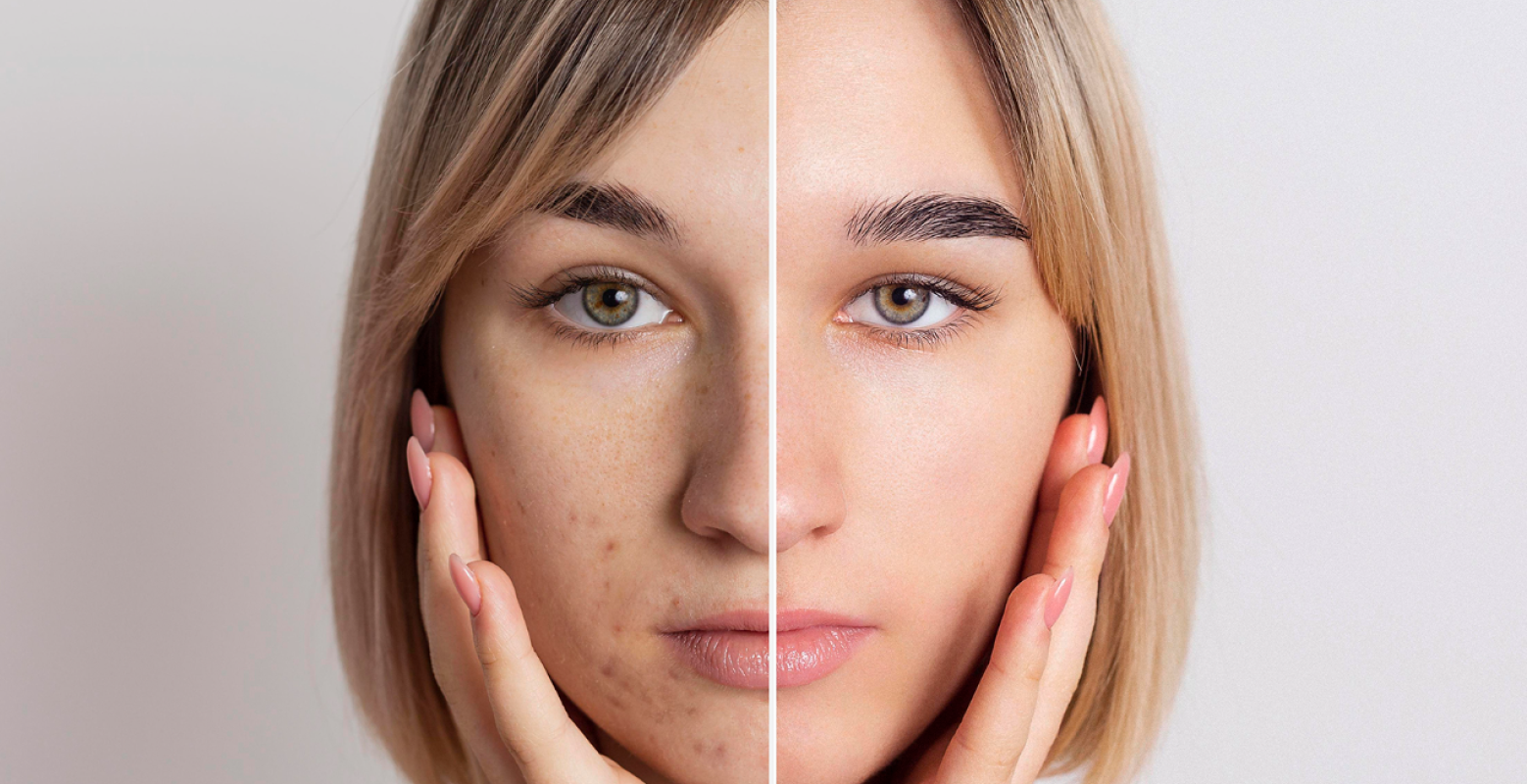 Розширені пори: проблема чи норма?